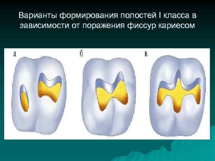 Варианты формирования полостей I класса в зависимости от поражения фиссур кариесом 