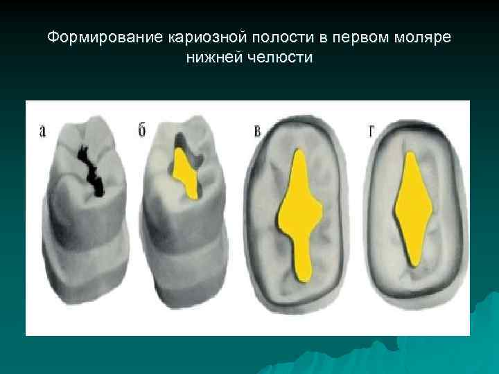 Формирование кариозной полости в первом моляре нижней челюсти 