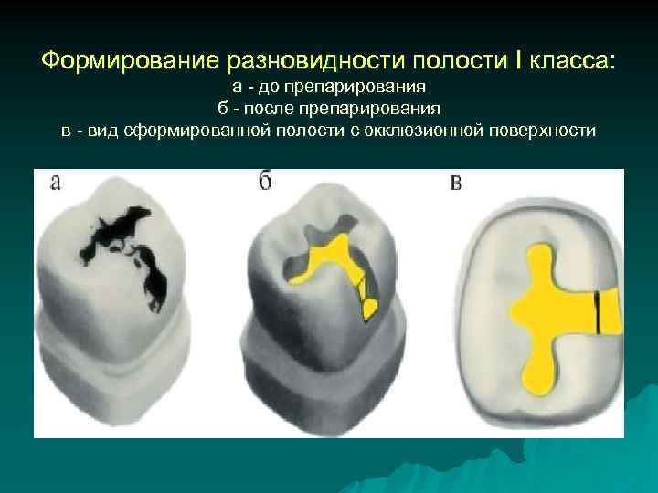 Формирование разновидности полости I класса: а - до препарирования б - после препарирования в