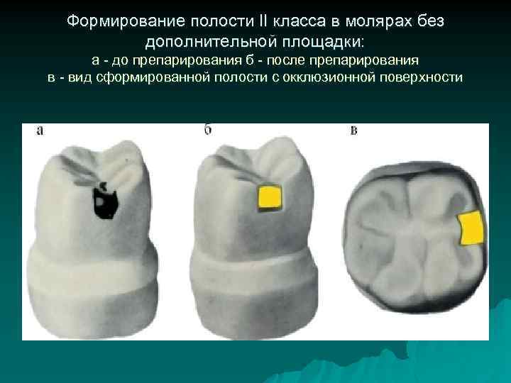 Формирование полости II класса в молярах без дополнительной площадки: а - до препарирования б