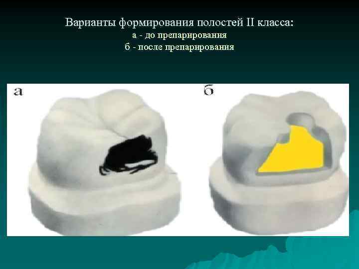 Варианты формирования полостей II класса: а - до препарирования б - после препарирования 