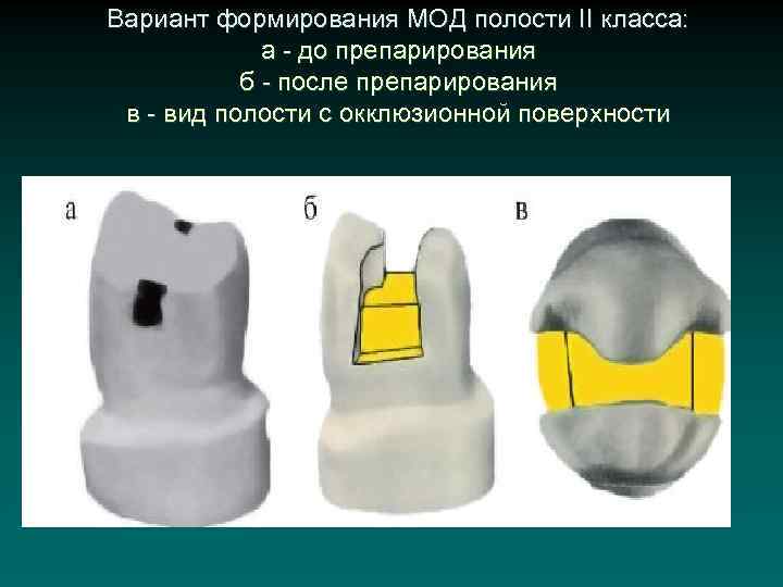 Вариант формирования МОД полости II класса: а - до препарирования б - после препарирования