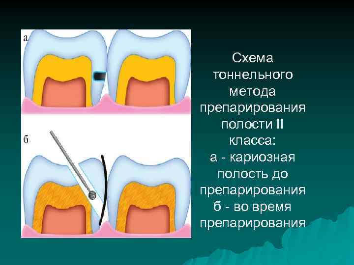 Схема тоннельного метода препарирования полости II класса: а - кариозная полость до препарирования б