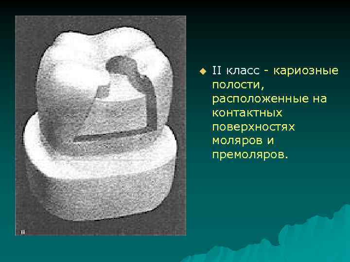 u II класс - кариозные полости, расположенные на контактных поверхностях моляров и премоляров. 