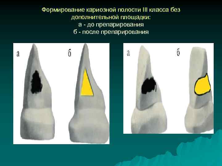 Формирование кариозной полости III класса без дополнительной площадки: а - до препарирования б -