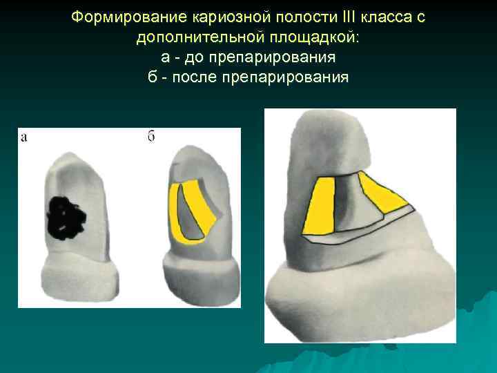 Формирование кариозной полости III класса с дополнительной площадкой: а - до препарирования б -