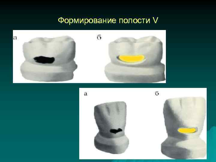 Формирование полости V 