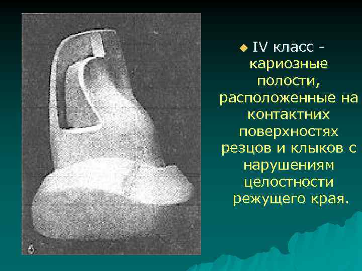 IV класс кариозные полости, расположенные на контактних поверхностях резцов и клыков с нарушениям целостности