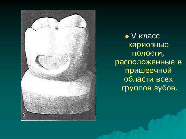 V класс кариозные полости, расположенные в пришеечной области всех группов зубов. u 