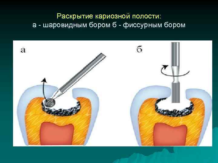 Раскрытие кариозной полости: а - шаровидным бором б - фиссурным бором 