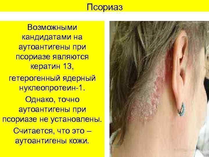 Псориаз Возможными кандидатами на аутоантигены при псориазе являются кератин 13, гетерогенный ядерный нуклеопротеин-1. Однако,