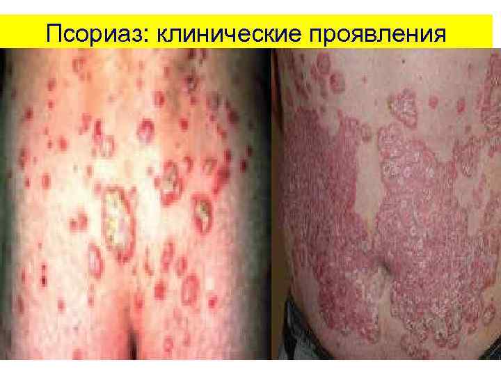 Псориаз: клинические проявления 