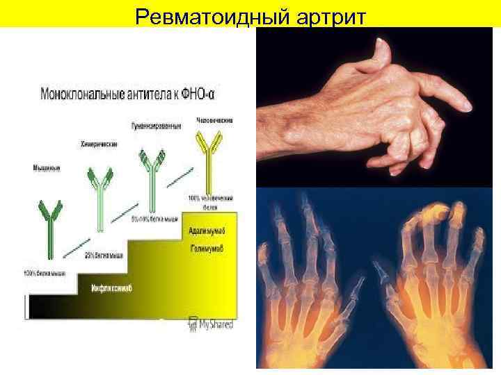 Ревматоидный артрит 