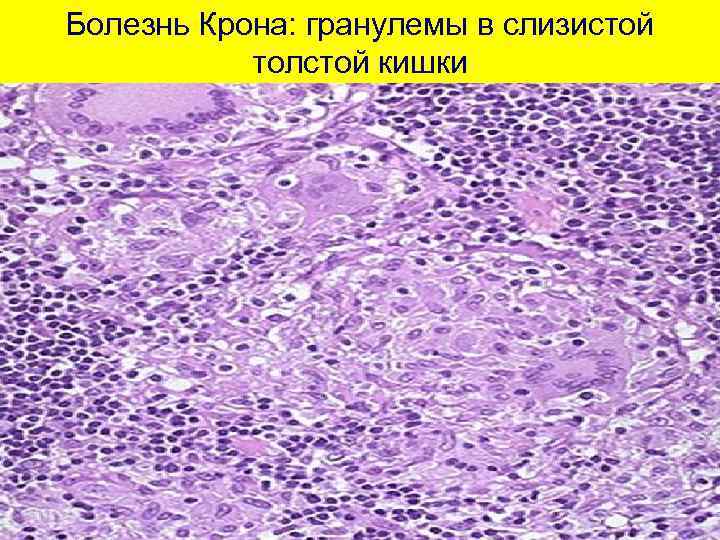 Болезнь Крона: гранулемы в слизистой толстой кишки 