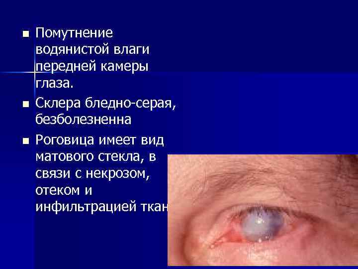 n n n Помутнение водянистой влаги передней камеры глаза. Склера бледно-серая, безболезненна Роговица имеет