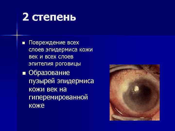 2 степень n n Повреждение всех слоев эпидермиса кожи век и всех слоев эпителия