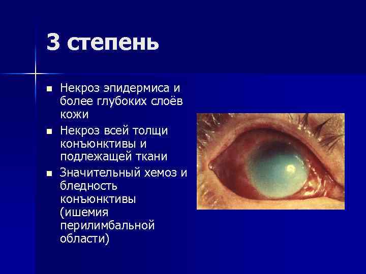 3 степень n n n Некроз эпидермиса и более глубоких слоёв кожи Некроз всей