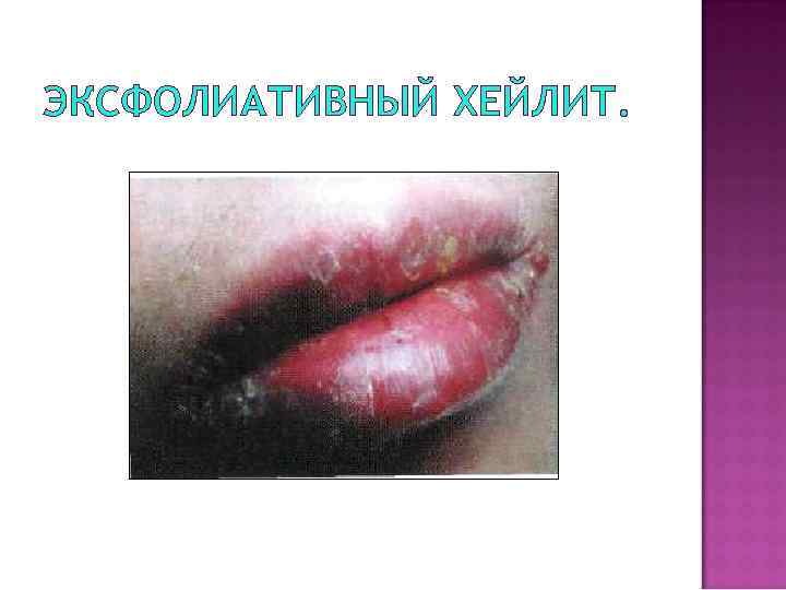 ЭКСФОЛИАТИВНЫЙ ХЕЙЛИТ. 