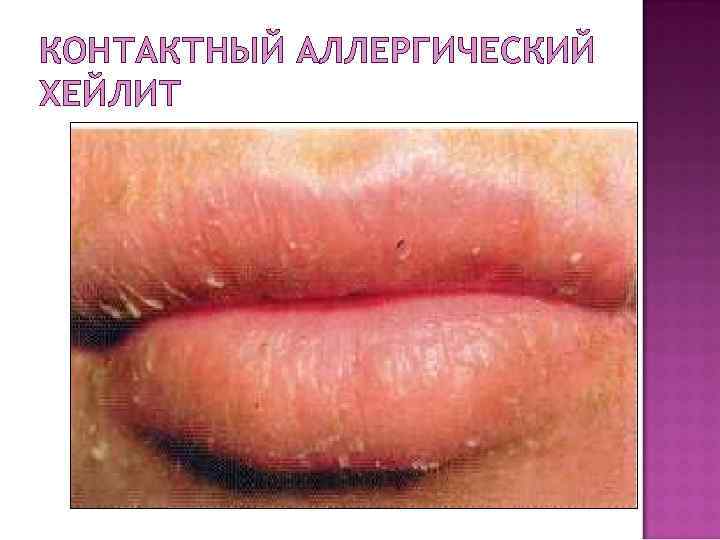 КОНТАКТНЫЙ АЛЛЕРГИЧЕСКИЙ ХЕЙЛИТ 