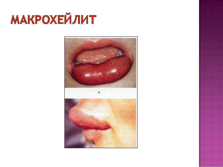 МАКРОХЕЙЛИТ 