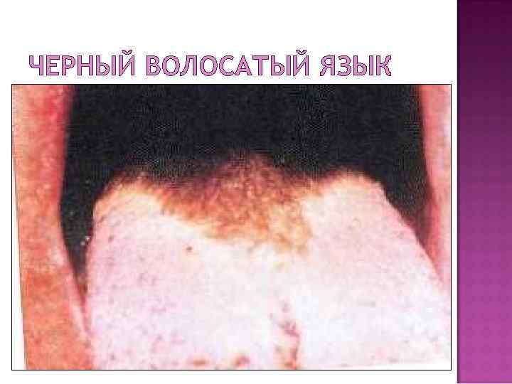 ЧЕРНЫЙ ВОЛОСАТЫЙ ЯЗЫК 