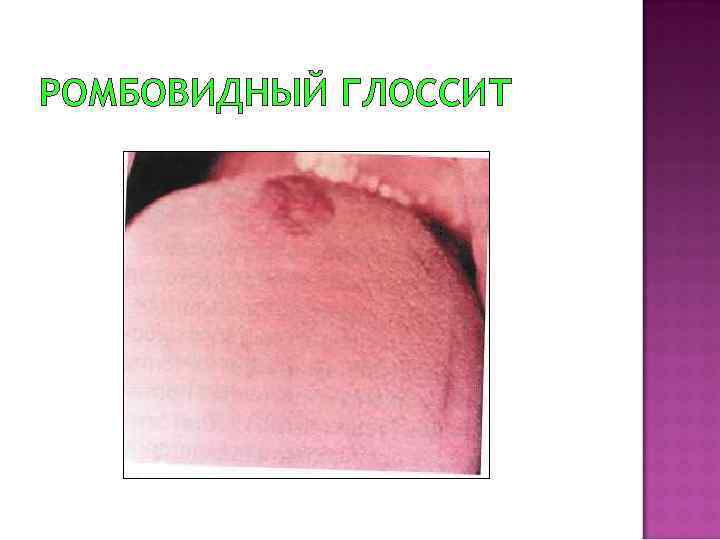 РОМБОВИДНЫЙ ГЛОССИТ 