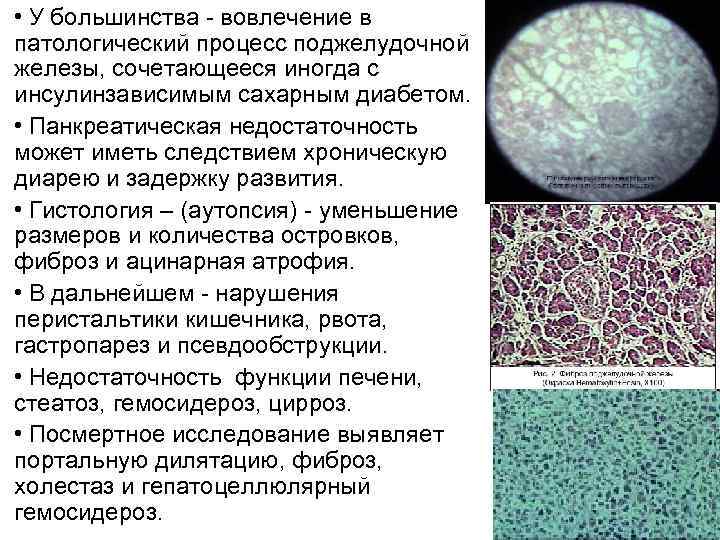  • У большинства - вовлечение в патологический процесс поджелудочной железы, сочетающееся иногда с