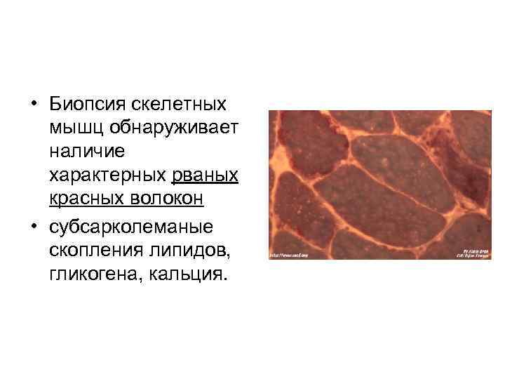  • Биопсия скелетных мышц обнаруживает наличие характерных рваных красных волокон • субсарколеманые скопления