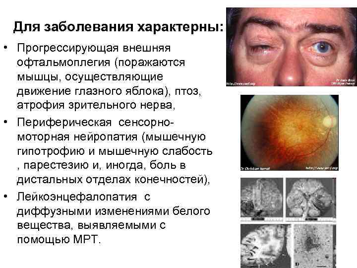 Для заболевания характерны: • Прогрессирующая внешняя офтальмоплегия (поражаются мышцы, осуществляющие движение глазного яблока), птоз,