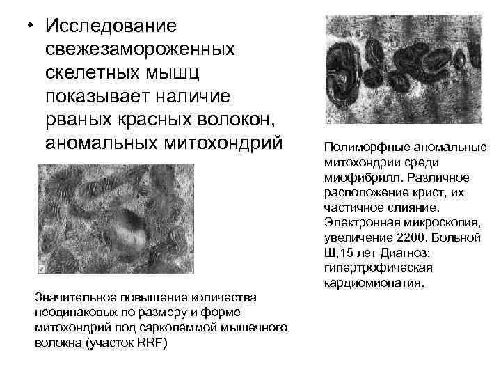  • Исследование свежезамороженных скелетных мышц показывает наличие рваных красных волокон, аномальных митохондрий Значительное