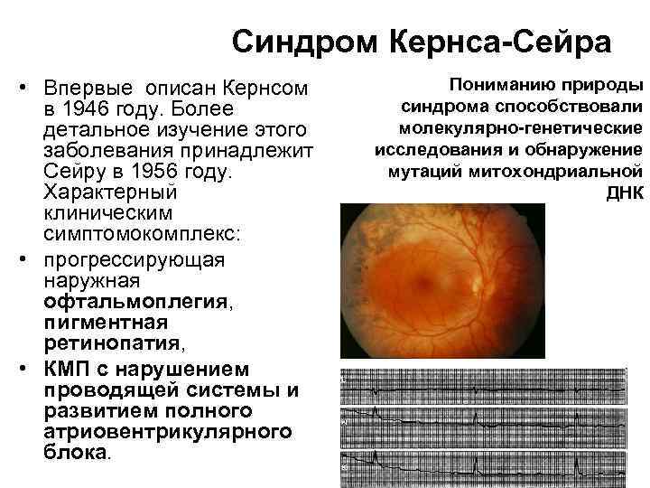 Синдром Кернса-Сейра • Впервые описан Кернсом в 1946 году. Более детальное изучение этого заболевания