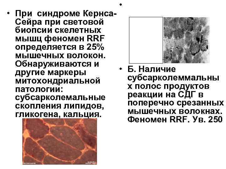  • • При синдроме Кернса. Сейра при световой биопсии скелетных мышц феномен RRF