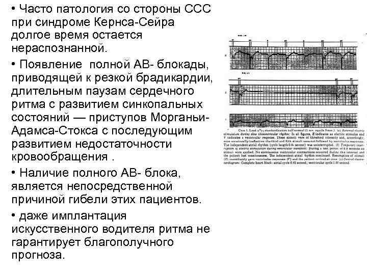  • Часто патология со стороны ССС при синдроме Кернса-Сейра долгое время остается нераспознанной.