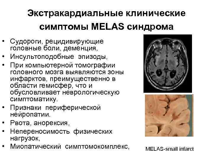 Экстракардиальные клинические симптомы MELAS синдрома • Судороги, рецидивирующие головные боли, деменция, • Инсультоподобные эпизоды,