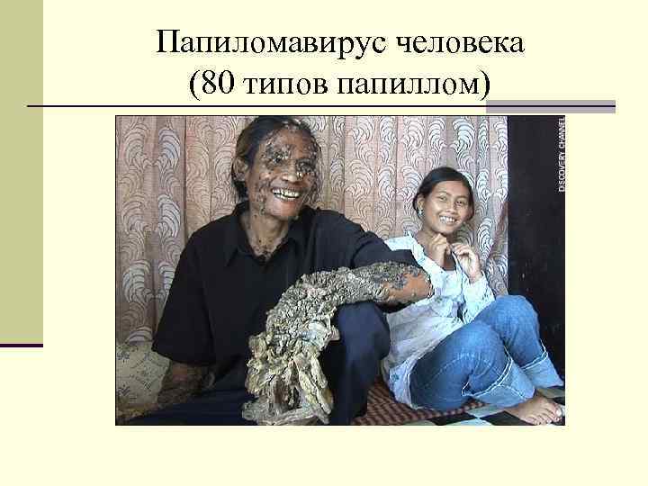 Папиломавирус человека (80 типов папиллом) 