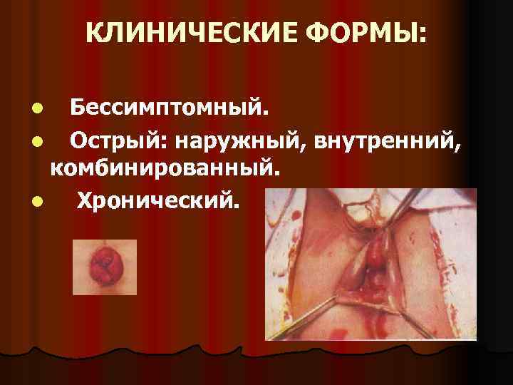 КЛИНИЧЕСКИЕ ФОРМЫ: l Бессимптомный. l Острый: наружный, внутренний, комбинированный. l Хронический. 