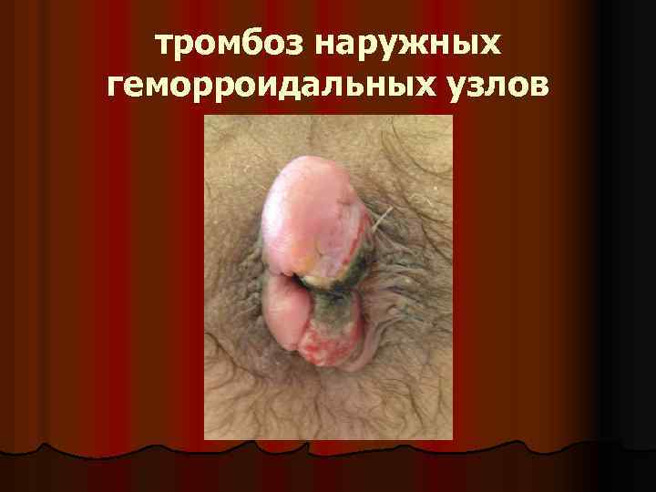 тромбоз наружных геморроидальных узлов 