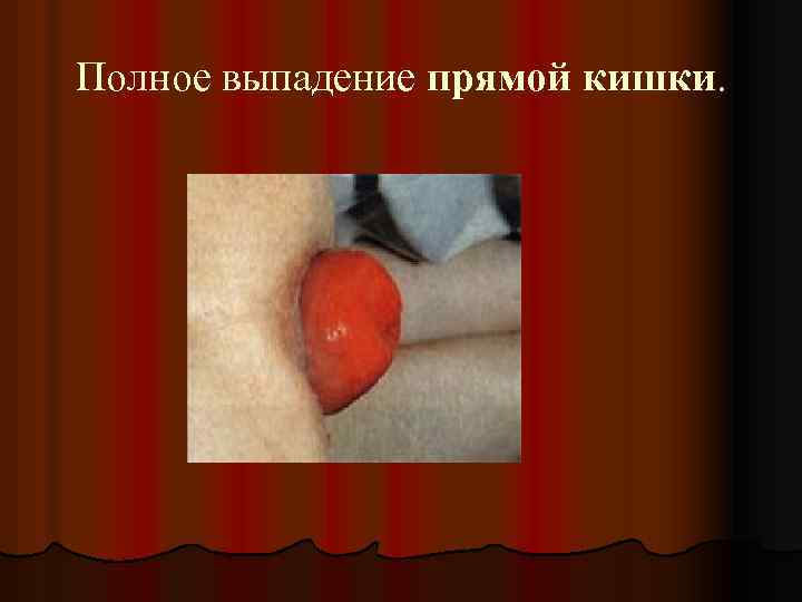 Полное выпадение прямой кишки. 