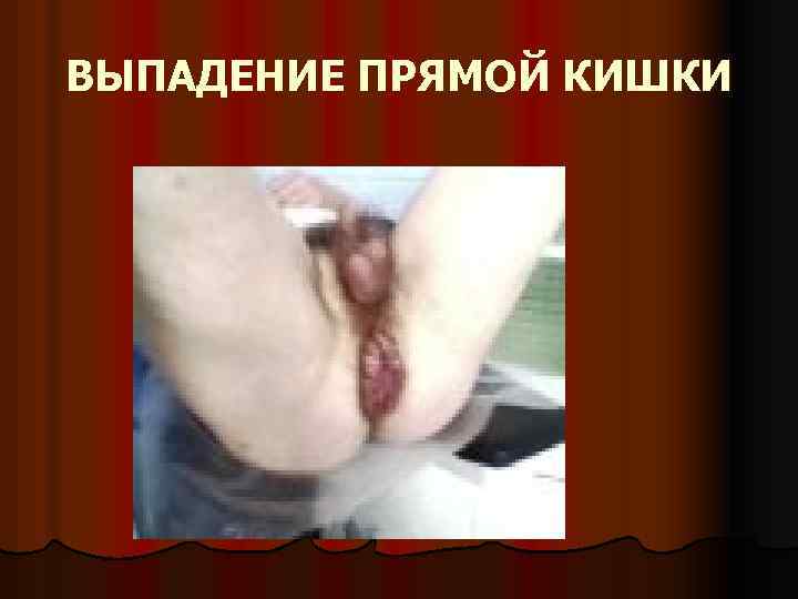ВЫПАДЕНИЕ ПРЯМОЙ КИШКИ 