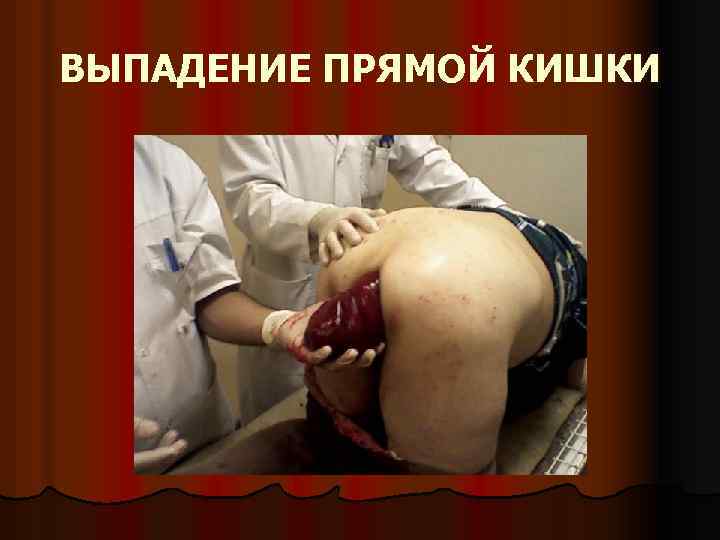 ВЫПАДЕНИЕ ПРЯМОЙ КИШКИ 