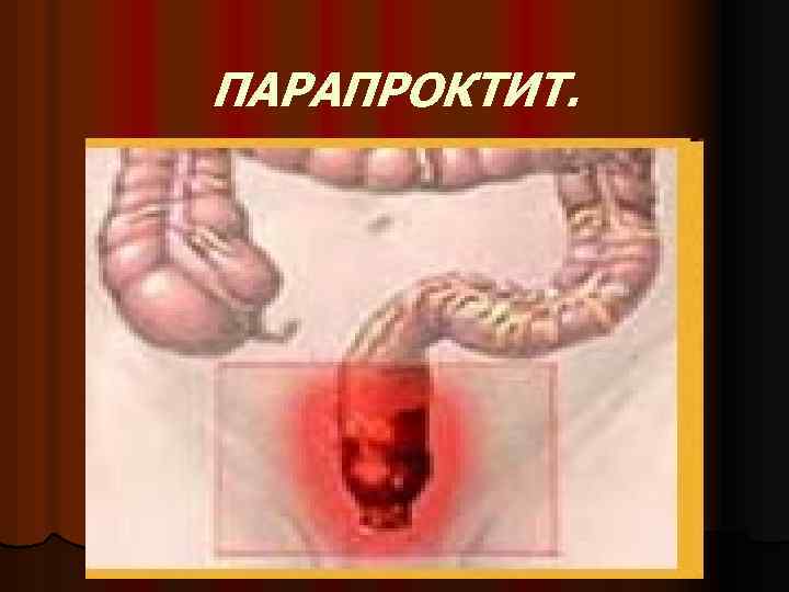 ПАРАПРОКТИТ. 