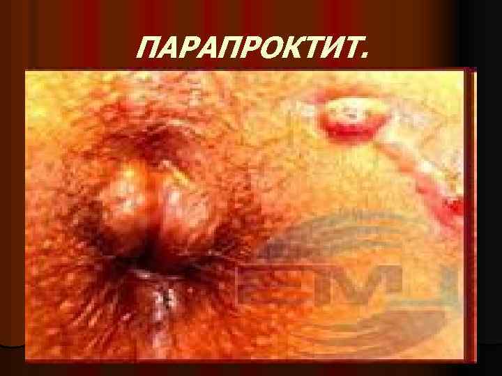 ПАРАПРОКТИТ. 