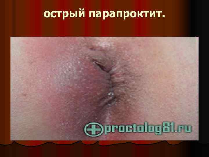 острый парапроктит. 