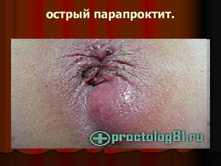 острый парапроктит. 
