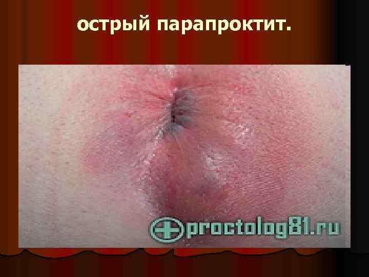 острый парапроктит. 