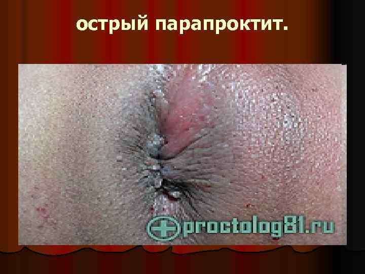 острый парапроктит. 