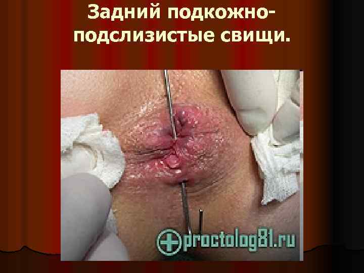 Задний подкожноподслизистые свищи. 