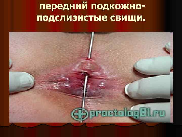  передний подкожноподслизистые свищи. 