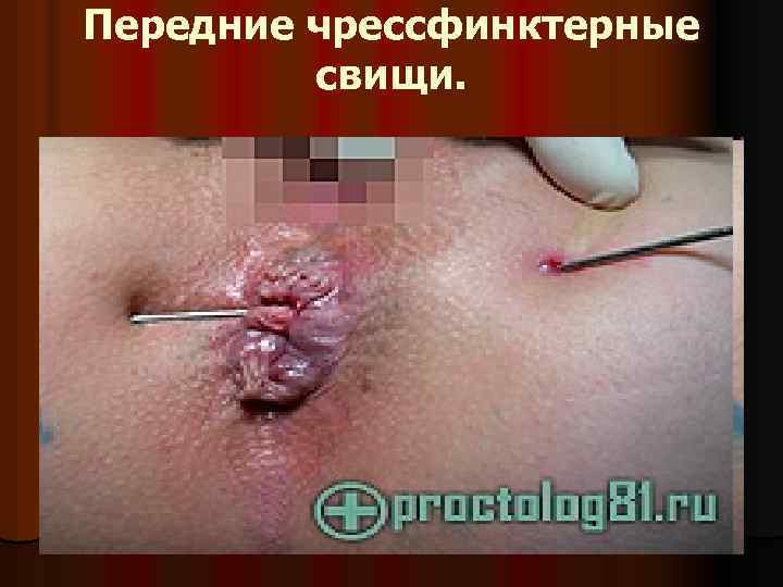 Передние чрессфинктерные свищи. 