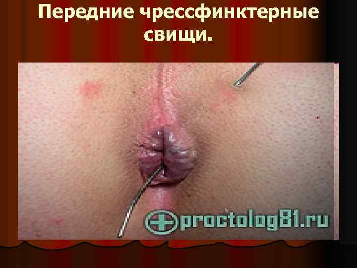 Передние чрессфинктерные свищи. 